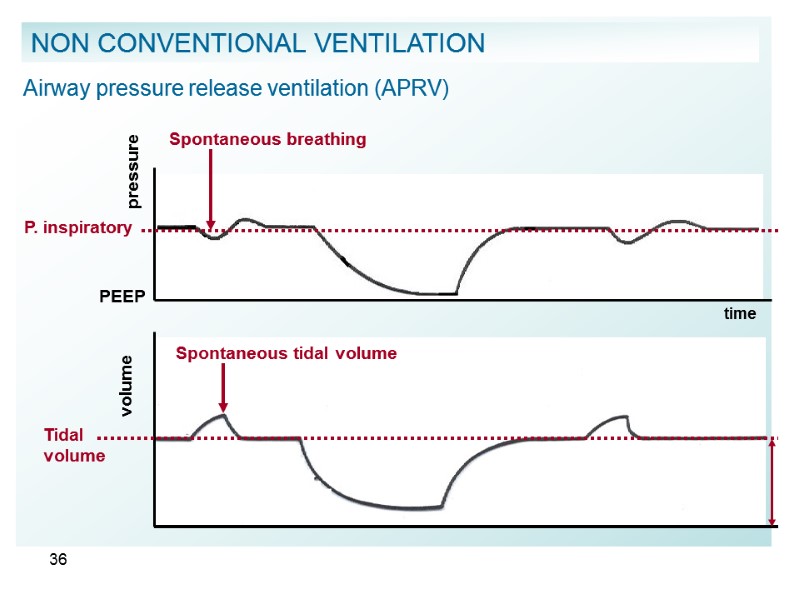 36   Airway pressure release ventilation (APRV)      